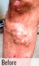 Varicose Vein before 1