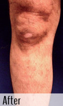 Varicose Vein after 1