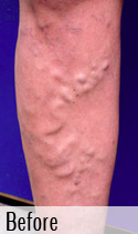 Varicose Vein before 3