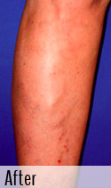 Varicose Vein after 3