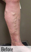 Varicose Vein before 4