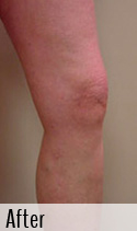 Varicose Vein after 4