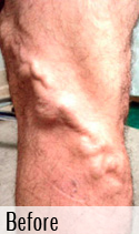 Varicose Vein before 2