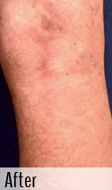 Varicose Vein after 2