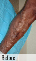 Varicose Vein before 5