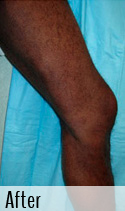 Varicose Vein after 5