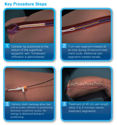 VNUS ClosureFAST steps