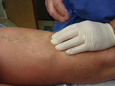 sclerotherapy