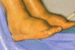 Foot ederma