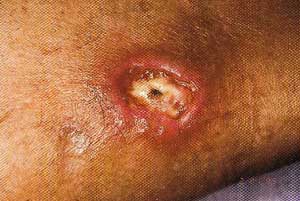 Venous Ulcer